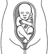An image of footling breech position where the baby’s foot or feet are below the bottom.