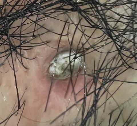 A thick crust of skin and debris under the processor, which can be itchy. The processor may cause discomfort and often fall off. Shown on the head of a person with white skin.